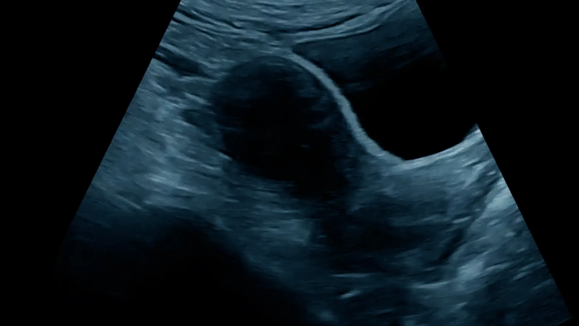 Female Pelvic Ultrasound The Ultrasound Suite