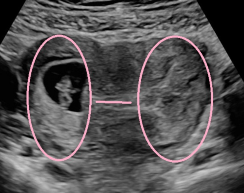 Abnormal Uterus Shapes What You Need To Know The Ultrasound Suitethe Ultrasound Suite 3250