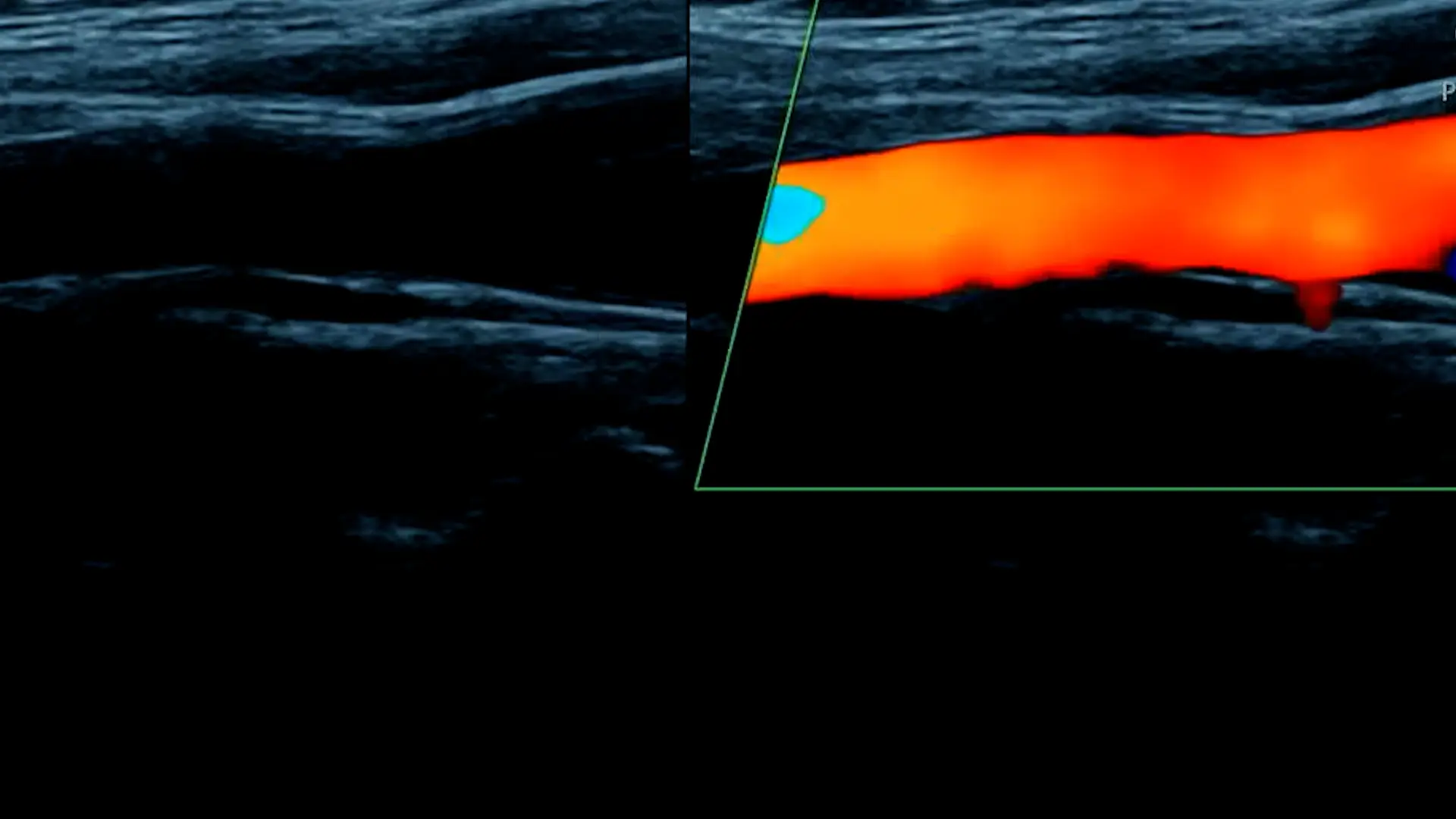 Venous Doppler Ultrasound - The Ultrasound Suite